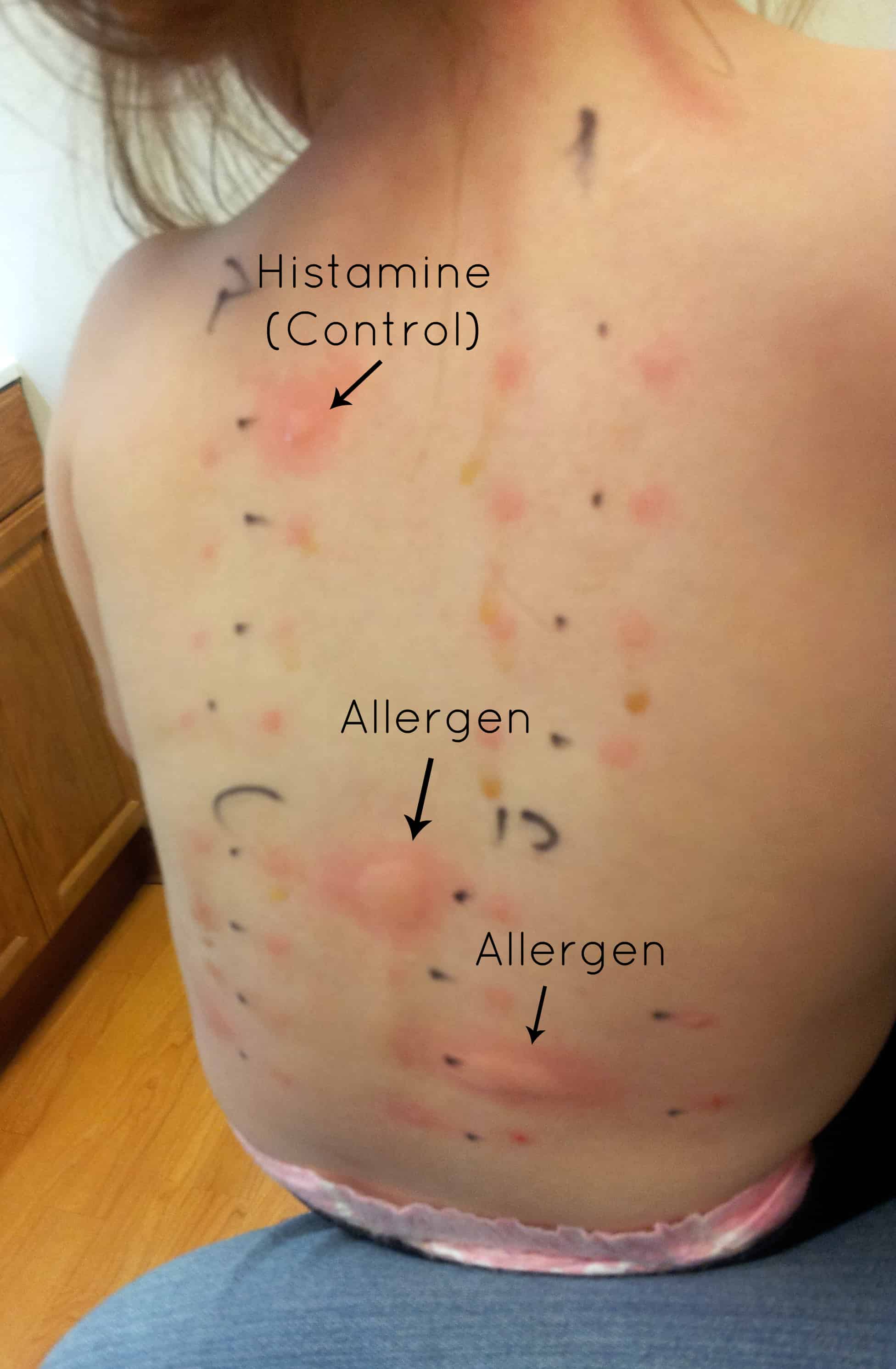 How Long To Allergic Reactions Last At Barbara Mccoy Blog