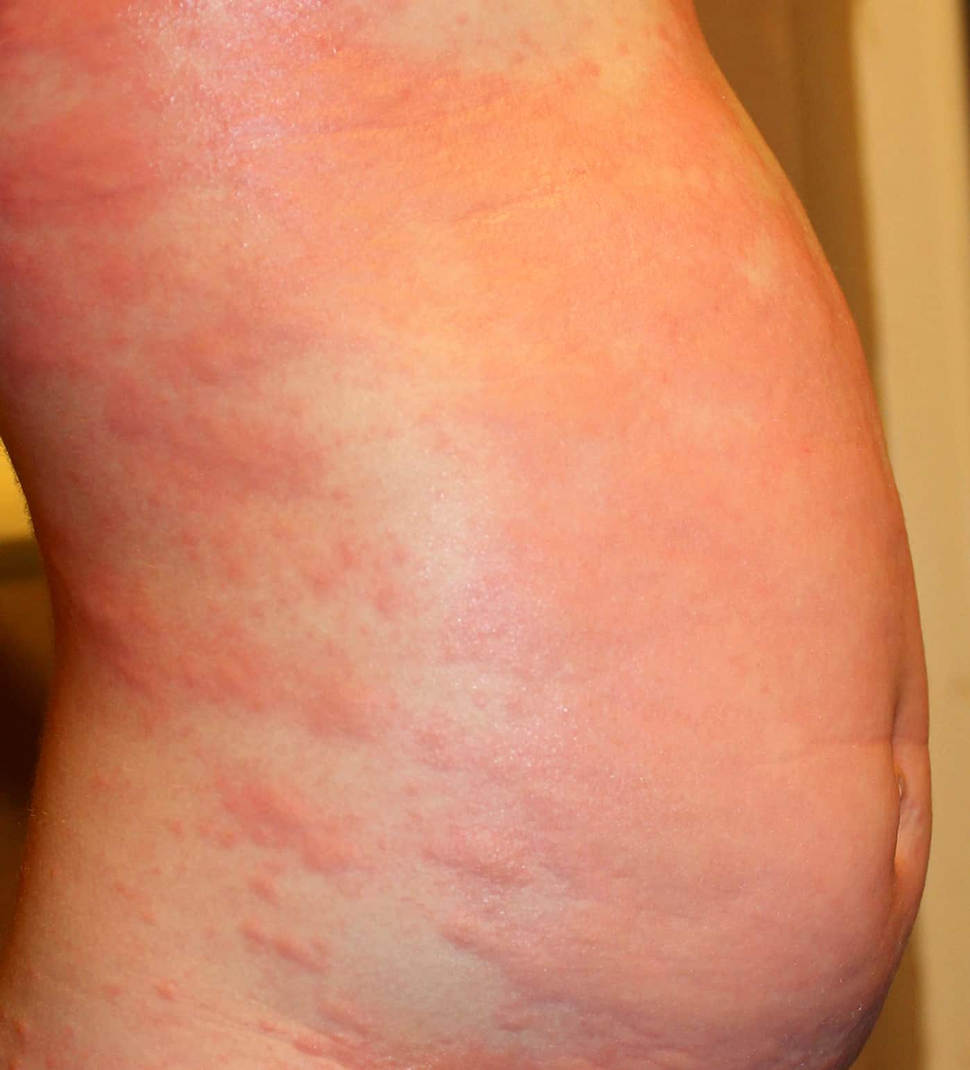 Hives