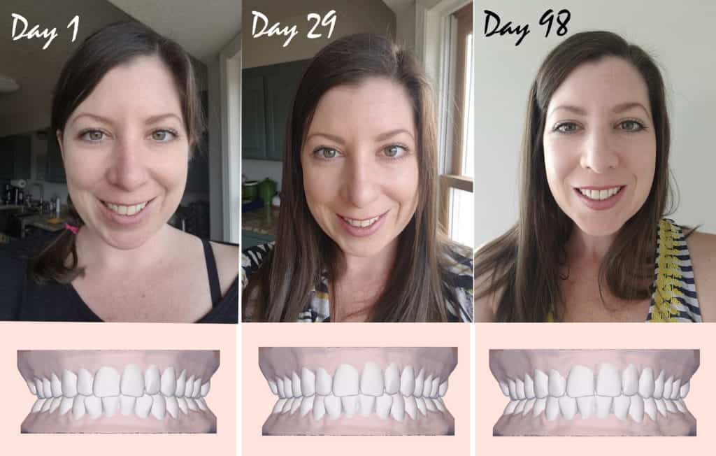 Invisible Braces 3 month update showing before and after pictures with Candid Co 