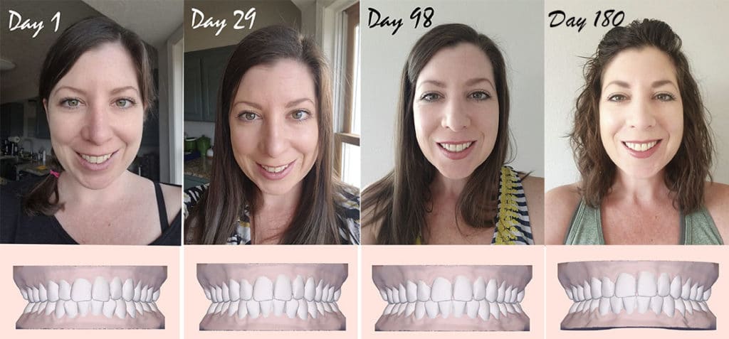 Candid Before and After Photos - Clear Aligners